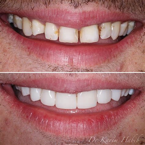 composite teeth veneers